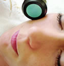 Microdermabrasion